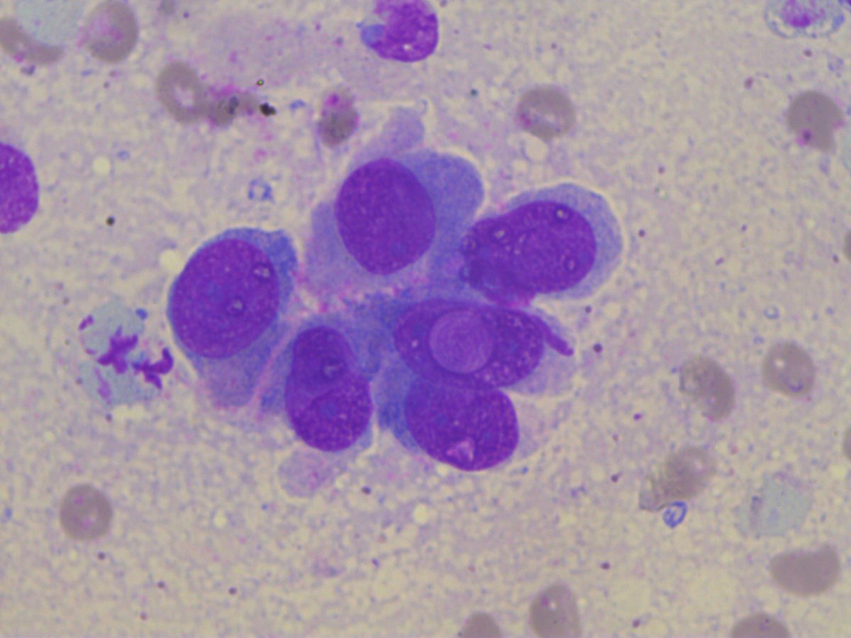 rep692's tweet photo. Intranuclear inclusions in adenocarcinoma of the common bile duct, intraoperative material #Intranuclear #inclusions https://t.co/ZCREcW4U7T
