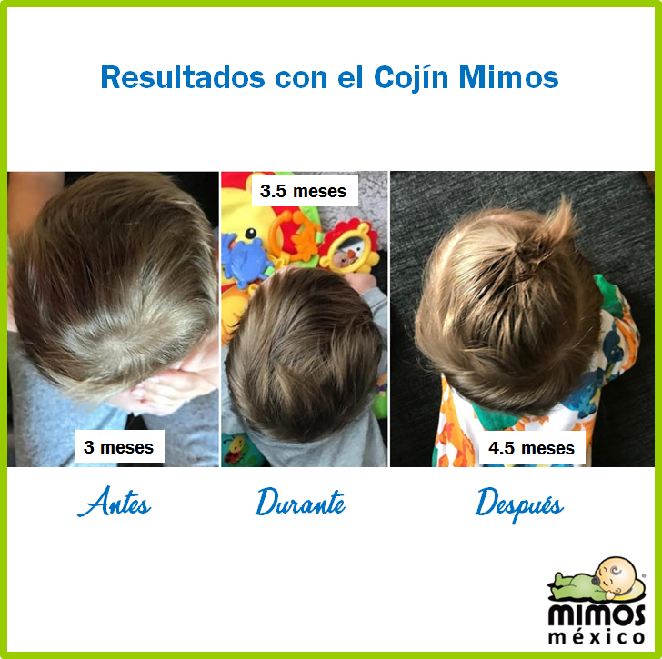 CojinMimosMex's tweet image. Les compartimos el resultado con el uso del Cojín Mimos . Esta bebita tenia plagiocefalia  a los 3 meses empezó a usar el cojín Mimos de manera constante  y obtuvo 🌟muy buenos resultados. #cojinmimos #mimospillow #cojinmimosmex #plagiocefalia #flathead