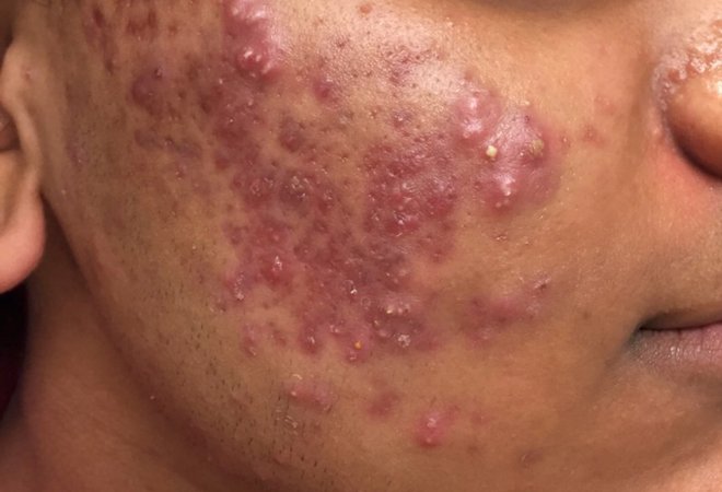 Your pimple is said to be inflamed when you experience swelling, redness and pores that are deeply clogged by bacteria, oils, and dead skin cells. Cystic acne is a common example and your regular pimple spot treatment won't work. Thread:Pls RT for someone