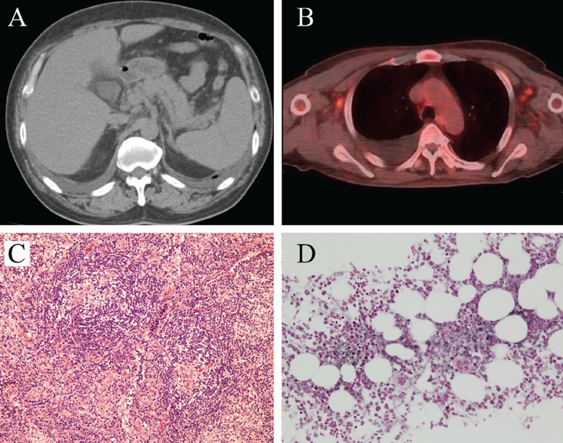 “A 54-year-old male patient presented with a 3-day history of fever. Physical examination revealed bilateral edema of lower extremities.'

You can reach our article titled as “TAFRO Syndrome”  from here! #balkanmedj #tafrosyndrome
More: balkanmedicaljournal.org/abstract.php?l…