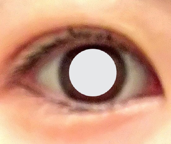美容垢 かわいいは作れる 10日目 寝起きのむくみは少しましに 赤みは完全になくなりました 二重整形 二重埋没 二重 埋没 埋没経過 美容垢 かわいいは作れる 10日目 寝起きのむくみは少しましに 赤みは完全になくなりました 二重整形 二重埋没 二重 埋没 埋没経過