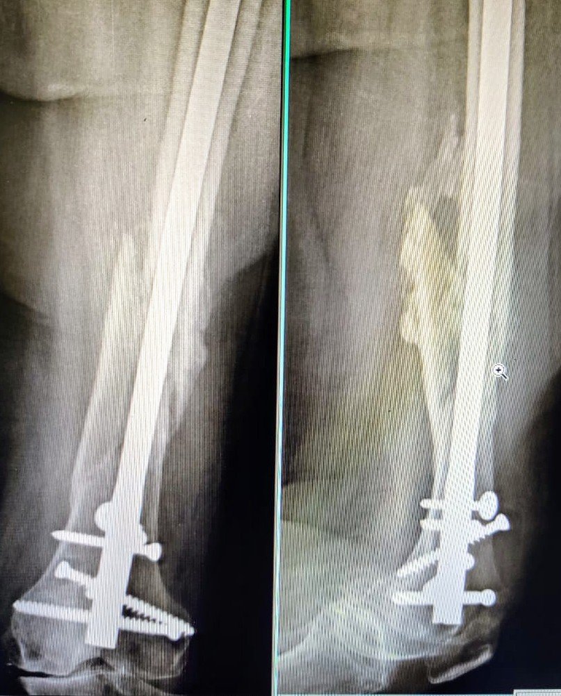 Orthoquote's tweet photo. A good example for understanding the concept of stress riser and how to avoid. 

#orthotwitter #Orthopedics #Trauma #Nonunion https://t.co/gx1KAmzMhc