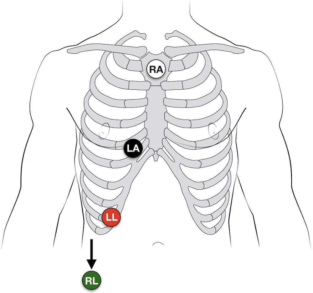 The Magical Lewis Lead to Differentiate SVT-AC vs VT via <a href="/amalmattu/">Amal Mattu</a> at #ResusX20 

-Better shows atrial activity
-RA --> Suprasternal Notch
-LA --> Rt 5th ICS next to sternum
-LL --> Rt lower costal margin

#FOAMed #ECG #EKG #FOAMcc