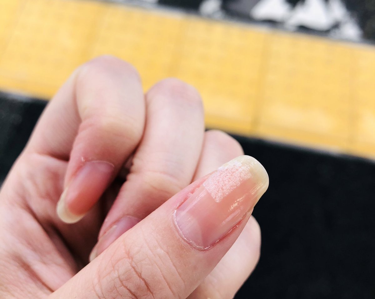 やたろ 仕事で機械類を扱った時に爪が持ってかれた 伸ばしすぎィ ので右手3本と左手1本の爪が横割れ してしまい ベースコートとおティッシュで無理やり固めてるんですけど ブス爪状態で人様に会うの恥ずかしい アア 右手は悲惨すぎて写真に やたろ 仕事で機械類を扱った時に爪が持ってかれた 伸ばしすぎィ ので右手3本と左手1本の爪が横割れ してしまい ベースコートとおティッシュで無理やり固めてるんですけど ブス爪状態で人様に会うの恥ずかしい アア 右手は悲惨すぎて写真に