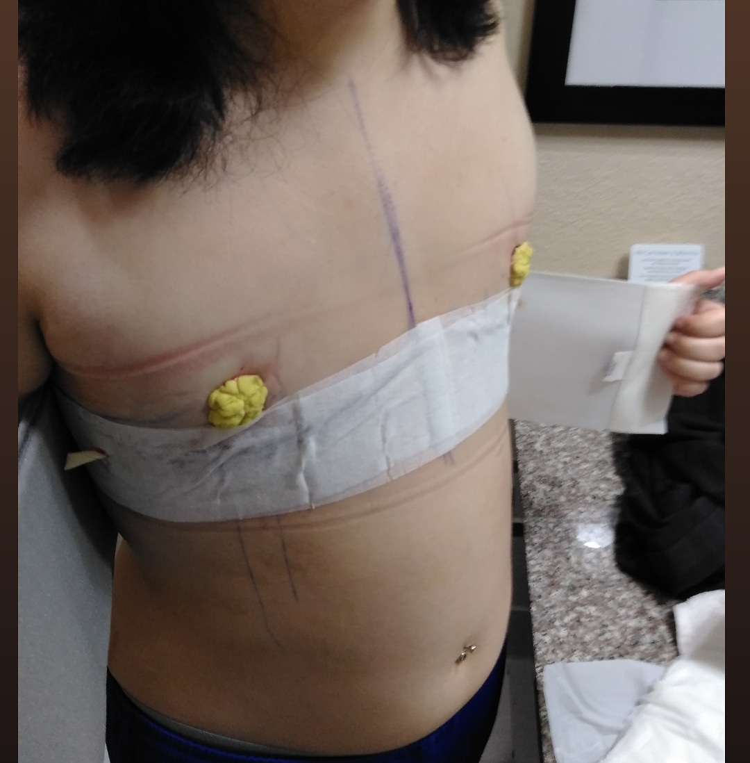 KrimzonHaven's tweet photo. Oooo its been done!!! #ftmtopsurgery #ftm https://t.co/qJqNaRco1q