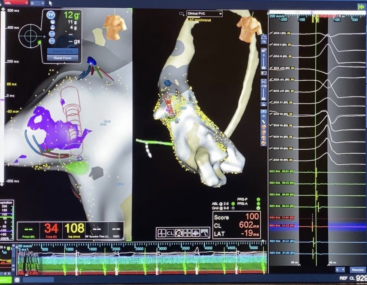 DrMCardiology's tweet photo. Satisfying PVC ablation in the left coronary sinus of valsalva using the #HDgrid. 33% burden. PVC initiated VT resulting in ICD Shocks. Suppressed immediately on contact. Thanks for the tips @PatelApoor @Jackson_J_Liang and support @Andrewsmom1996 @NormM_EnSite #ensite #EPEEPS https://t.co/OFojQsqnUg