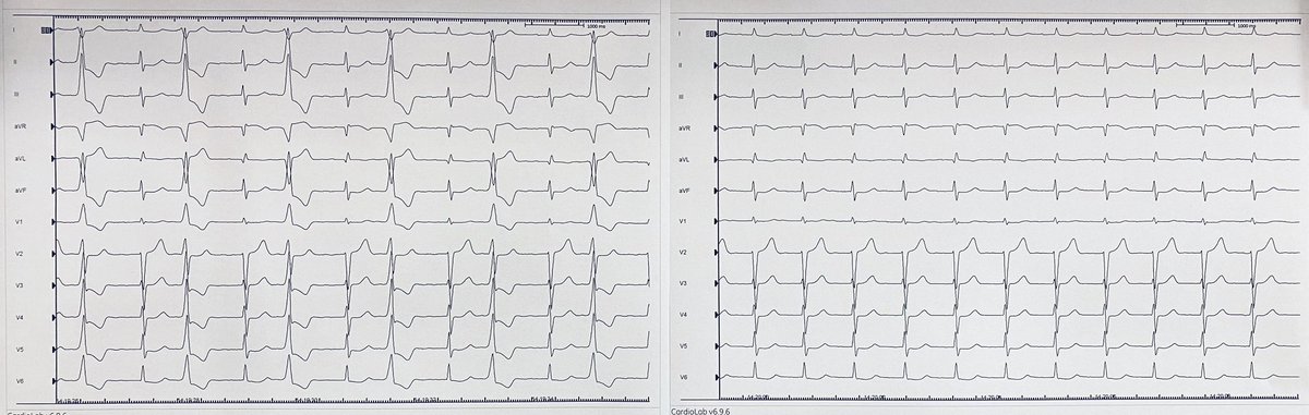 DrMCardiology's tweet photo. Satisfying PVC ablation in the left coronary sinus of valsalva using the #HDgrid. 33% burden. PVC initiated VT resulting in ICD Shocks. Suppressed immediately on contact. Thanks for the tips @PatelApoor @Jackson_J_Liang and support @Andrewsmom1996 @NormM_EnSite #ensite #EPEEPS https://t.co/OFojQsqnUg