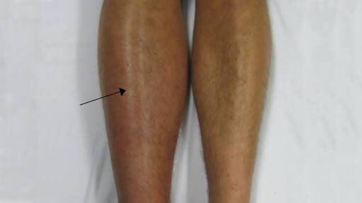 What are the signs and symptoms of DVT?Swelling in the affected leg. Rarely, there's swelling in both legs.Pain in your leg. The pain often starts in your calf and can feel like cramping or soreness.Red or discolored skin on the leg.A feeling of warmth in the affected leg.