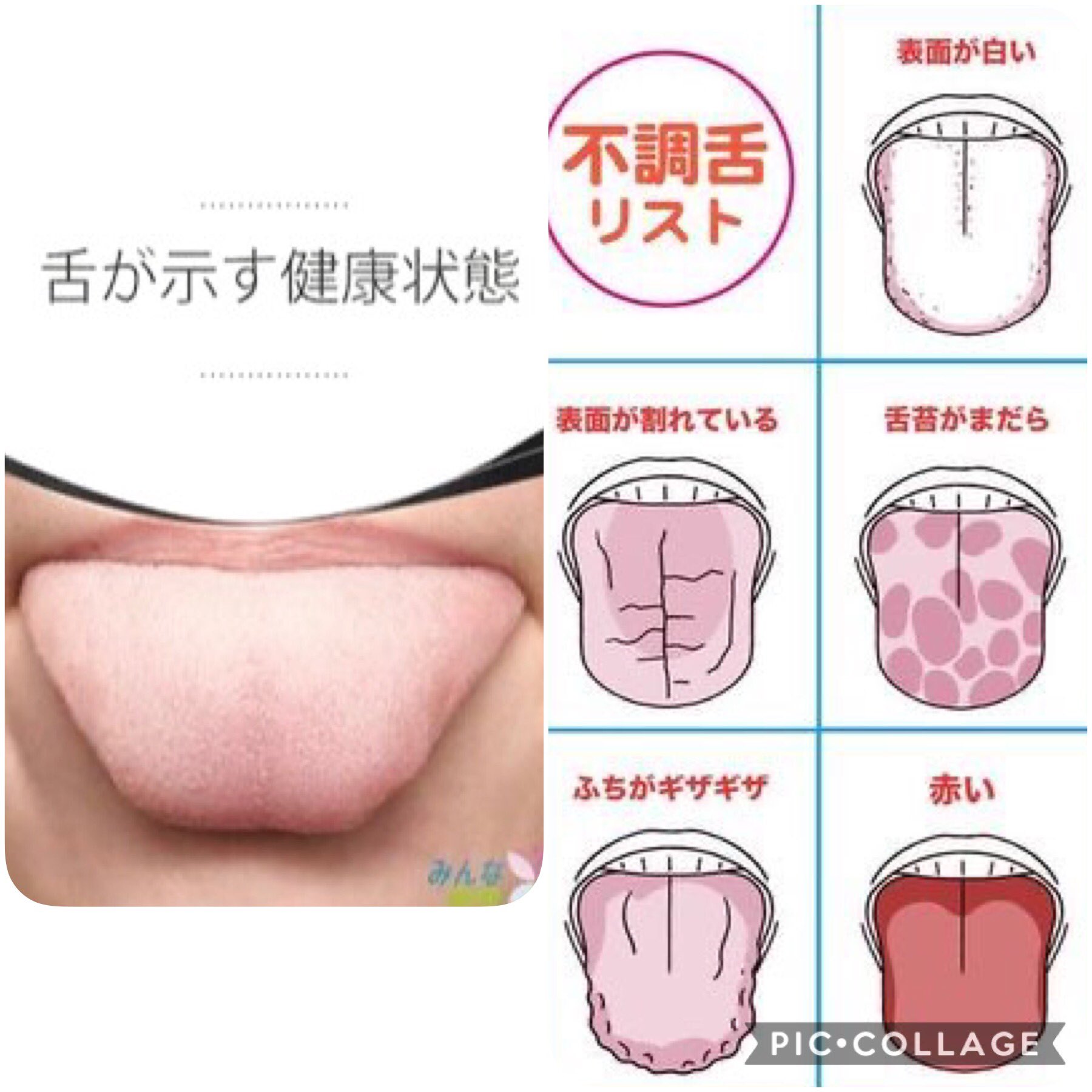 江崎 文泰 フミ や あなたは 舌をみてください あなたの舌が薄い赤色か 紅色ですか あなたは健康です 右の写真は 健康ではありません あなたは病院か 薬屋に行ってください そこで 話してください T Co Nsa3wat70p Twitter