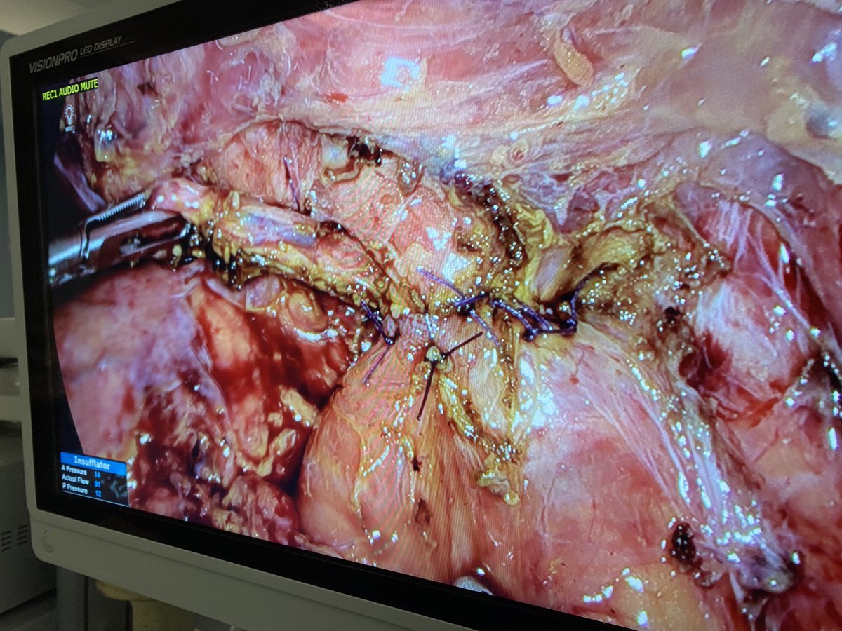 Cirugía HBP y Gástrica H. Arnau de Vilanova Lérida (@hbp_eglleida) on Twitter photo Coledocoduodenostomía laparoscópica en paciente con coledocolitiasis múltiple sintomática y antecedente de gastrectomía subtotal <a href="/HelenaSalvadorR/">Helena Salvador</a> y Dr. <a href="/JimyJara/">Jimy Jara</a> <a href="/aecirujanos/">aecirujanos</a> @seccionhbpaec <a href="/aecformacion/">AEC Formación</a> <a href="/SeclaEndosurg/">SECLA</a> <a href="/harnaulleida/">Hospital Universitari Arnau de Vilanova</a> Coledocoduodenostomía laparoscópica en paciente con coledocolitiasis múltiple sintomática y antecedente de gastrectomía subtotal <a href="/HelenaSalvadorR/">Helena Salvador</a> y Dr. <a href="/JimyJara/">Jimy Jara</a> <a href="/aecirujanos/">aecirujanos</a> @seccionhbpaec <a href="/aecformacion/">AEC Formación</a> <a href="/SeclaEndosurg/">SECLA</a> <a href="/harnaulleida/">Hospital Universitari Arnau de Vilanova</a>