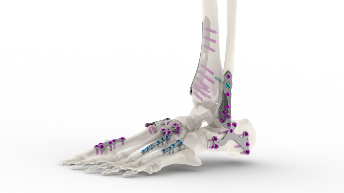 Tyber Medical, LLC, received a U.S. Food and Drug Administration (FDA) 501(k) clearance for its new line of foot and ankle plating systems that covers 42 different indication-specific anatomical plating families. prn.to/3dVR6zn