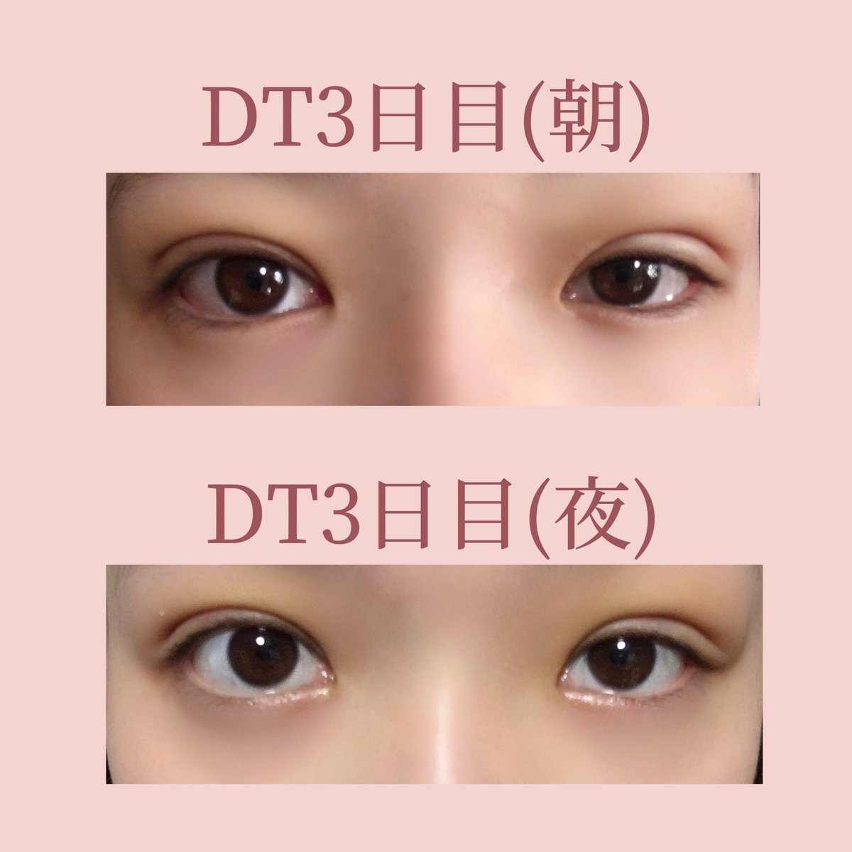 Dt3日目 右目はもう一息だけどなんだかとってもいい感じ 両目ともにぷっくり感はあるけど幅自体はここで確定かな まだ狭まる 急性炎症は冷やす 慢性炎症は温めるのがいいらしいから術後72時間経ったし明日からは血行を良くするのも意識して