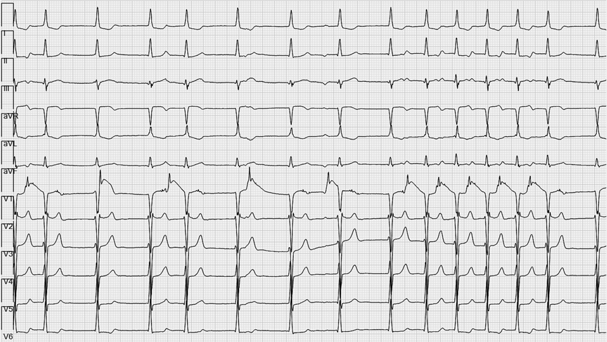 CircAHA's tweet photo. #CircECG: 22 yo M with ESRD underwent valve surgery for bacterial endocarditis. On POD#2, developed tachyarrhythmia (Fig1). Repeat ECG with diagnostic maneuver (Fig2). What is the maneuver &amp; what is the rhythm? https://t.co/hshgdkEgpt #AHAjournals  @KennethEllenbo1 @ravichoxi https://t.co/S5Mv8dNytk