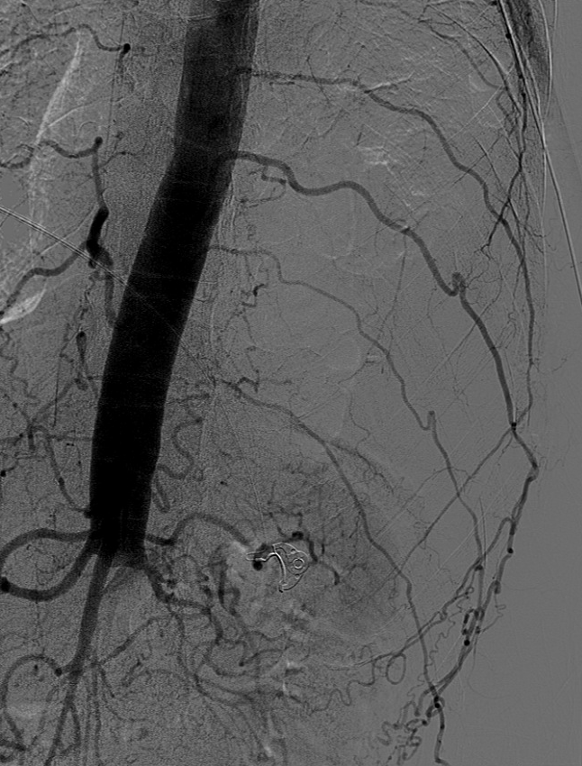 urmed_ir's tweet photo. Fall with rib fractures and active extrav on the chest CT. No active extrav on angio but 💣🔥 partially visualized aortoiliac occlusive disease (Leriche syndrome)...🐙🐙🐙

#Irad #TwittIR #InnovationToHeal #Interventional #radiology https://t.co/GKnzZqpfrs