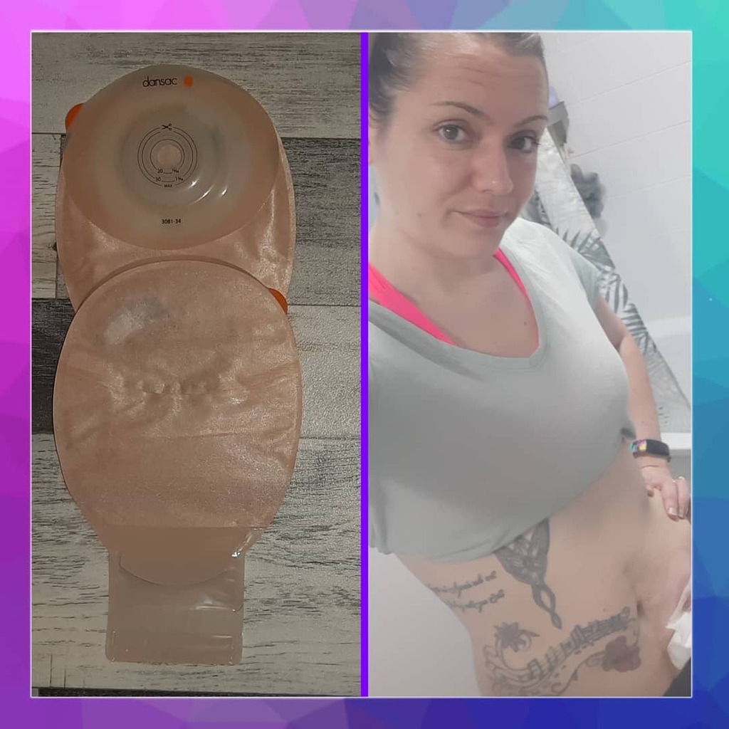 4 hrs after sticking on the Dansac 🙈

Thank you, NEXT! 🚪

#IBDSuperHeroes #Ostomate #Stoma #Ileostomy #Ostomy #Colostomy #OnlineOstomy #StomaSquad #OstomyAwareness #OstomyInspo #StomaTips #Crohns #Colitis #IBD #CrohnsDisease #UlcerativeColitis #IBDaw… instagr.am/p/CGnpDqyD2oL/