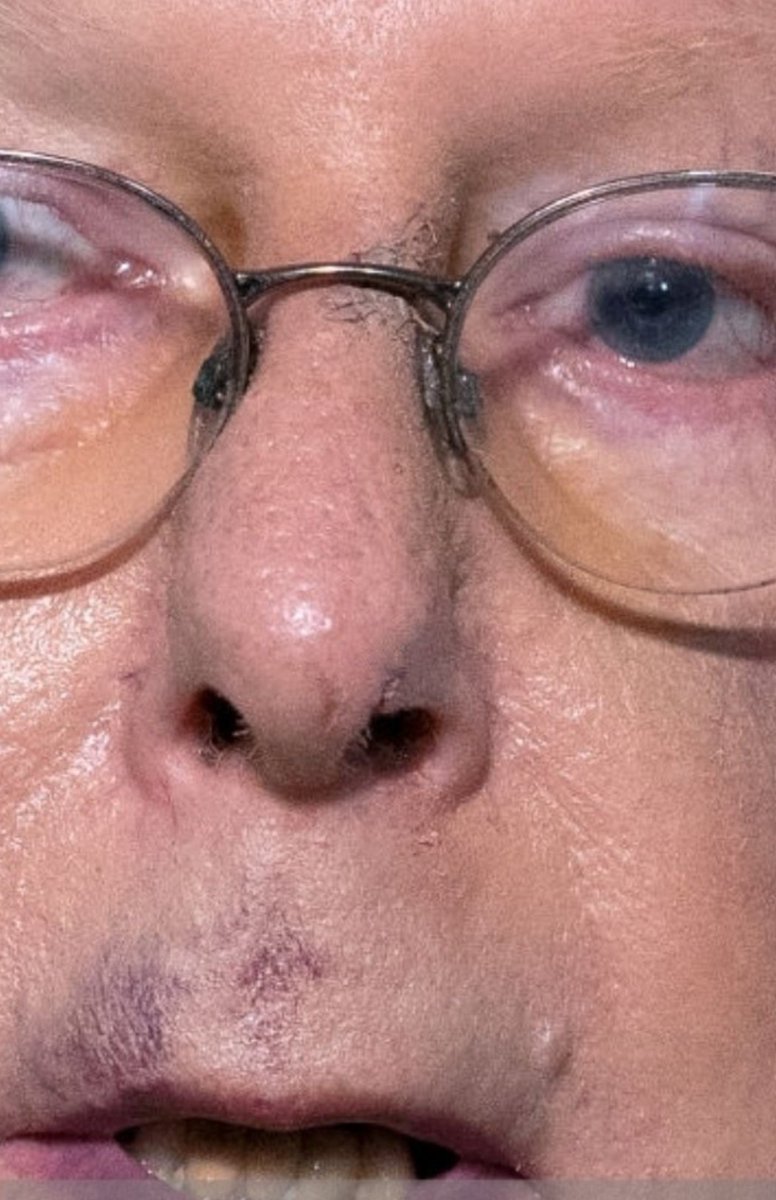Looks like McConnell uses makeup to cover some of the issues on his face The whites of his eyes don't look jaundiced Hands don't look like Raynaud's to me but I'm no expert Something is clearly wrong