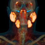 「ｔｕｂａｒｉａｌ　ｇｌａｎｄｓ」人間の喉の奥には「未知の臓器」が隠されていた!うそでしょっっ!!