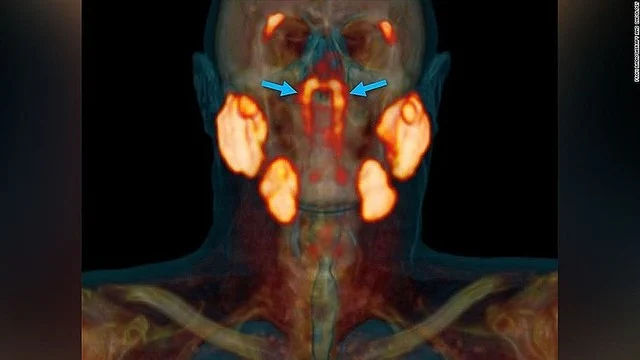 「ｔｕｂａｒｉａｌ　ｇｌａｎｄｓ」人間の喉の奥には「未知の臓器」が隠されていた！うそでしょっっ！！！