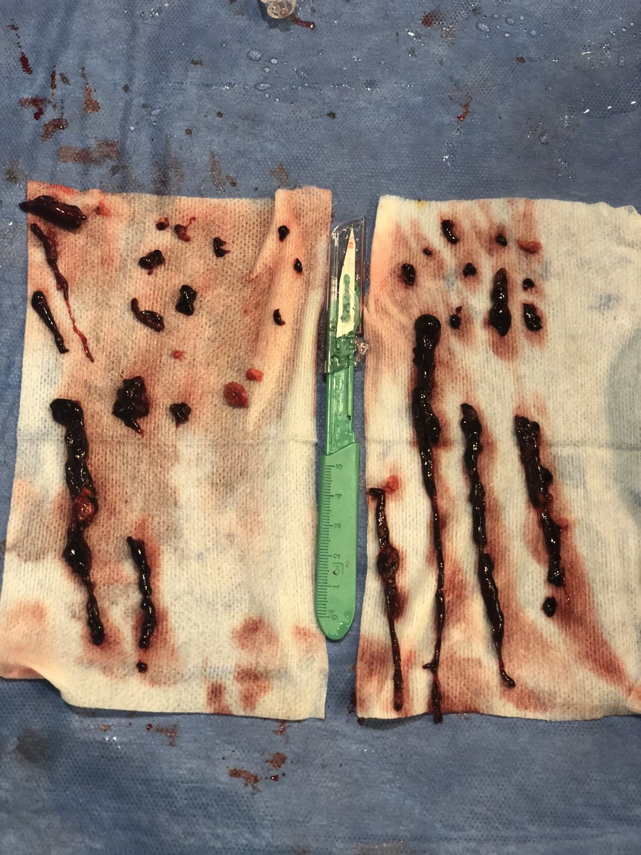 I’m a believer. Today we had a massive PE, and within 13 minutes after venous access Inari’s Flowtreiver was pulling thrombus. Systolic PA pressure: 48–&gt;24. 2 hours later the patient was off O2. Perhaps a game changer for massive PE during normal hours? #inarimedical