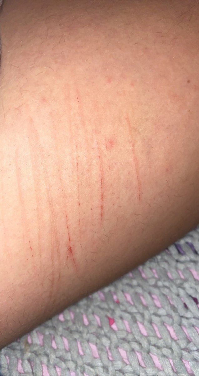 Bl4AD3's tweet photo. TW: SH/CUTS
.
.
.
.
.
.
.
.
.
.
.
.
.
.
.
.
.
.
.
Some more baby cuts on my legs for now i haven’t been able to do styro on my legs because they’re so sore from running a mile or more everyday :/. also proud of myself because i haven’t eaten anything for awhile and im losing!! https://t.co/6OjDZSO7gb