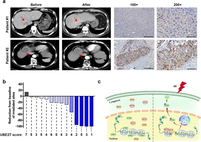 JournalofExper1's tweet image. New Research! 

𝐔𝐁𝐄𝟐𝐓-regulated 𝐇𝟐𝐀𝐗 monoubiquitination induces 𝐡𝐞𝐩𝐚𝐭𝐨𝐜𝐞𝐥𝐥𝐮𝐥𝐚𝐫 𝐜𝐚𝐫𝐜𝐢𝐧𝐨𝐦𝐚 𝐫𝐚𝐝𝐢𝐨𝐫𝐞𝐬𝐢𝐬𝐭𝐚𝐧𝐜𝐞 by facilitating CHK1 activation

#Radioresistance
#HepatocellularCarcinoma
#CellCycleArrest

Full paper 
jeccr.biomedcentral.com/articles/10.11…