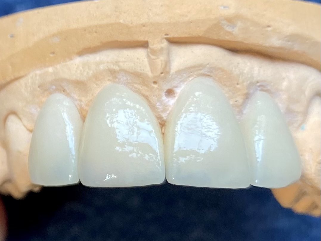 thedentallabltd's tweet photo. Pressed emax veneer case. We very often get pre opp photos of original dentition and underlying preps, which really help!
#thedentallabltd
#dentallaboratory
#cosmeticdentistry
#aestheticdentistry
#newsmiles
#dentaltechnician
#ivoclarvivadent
#dentaltechnology
#emaxpress https://t.co/ccbdtRL8fb