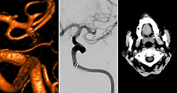 LINNConline's tweet photo. Dive into this new case report of a Tiger 13 #stentectomy performed by @VladoKZg, @Branketara, Dr. Ante Rotim and Dr.Josip Savić (KBC Sestre Milosrdnice, Croatia)! https://t.co/e8CsH605Vk https://t.co/7qlizy6uE5