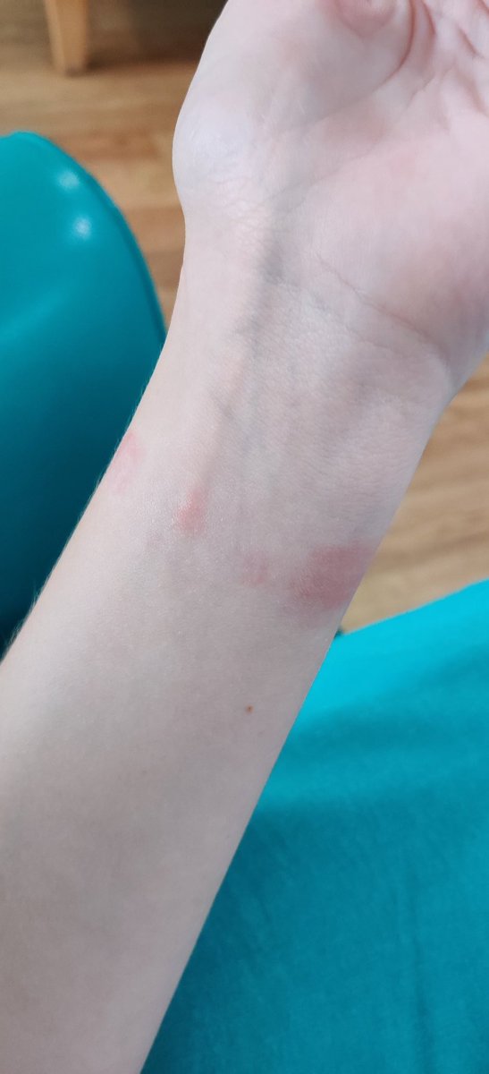 Itsjusttaaylor's tweet photo. Got a strange bruise, maybe allergic reaction, right under my Fitbit strap 

Been wearing it for months and no problems but suddenly this happens https://t.co/QMYo7EpFlF