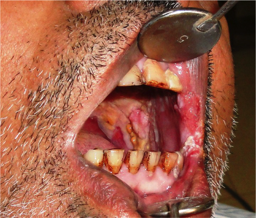 vinaypushpa's tweet photo. Flavo plakia a term used for  diffuse yellowish patches in oral cavity often not associated with tobacco chewing or smoking is suggestive of Oral proliferative Verrucous leukoplakia the most sinister among oral potentially malignant disorders. https://t.co/Xoiob7YMNQ