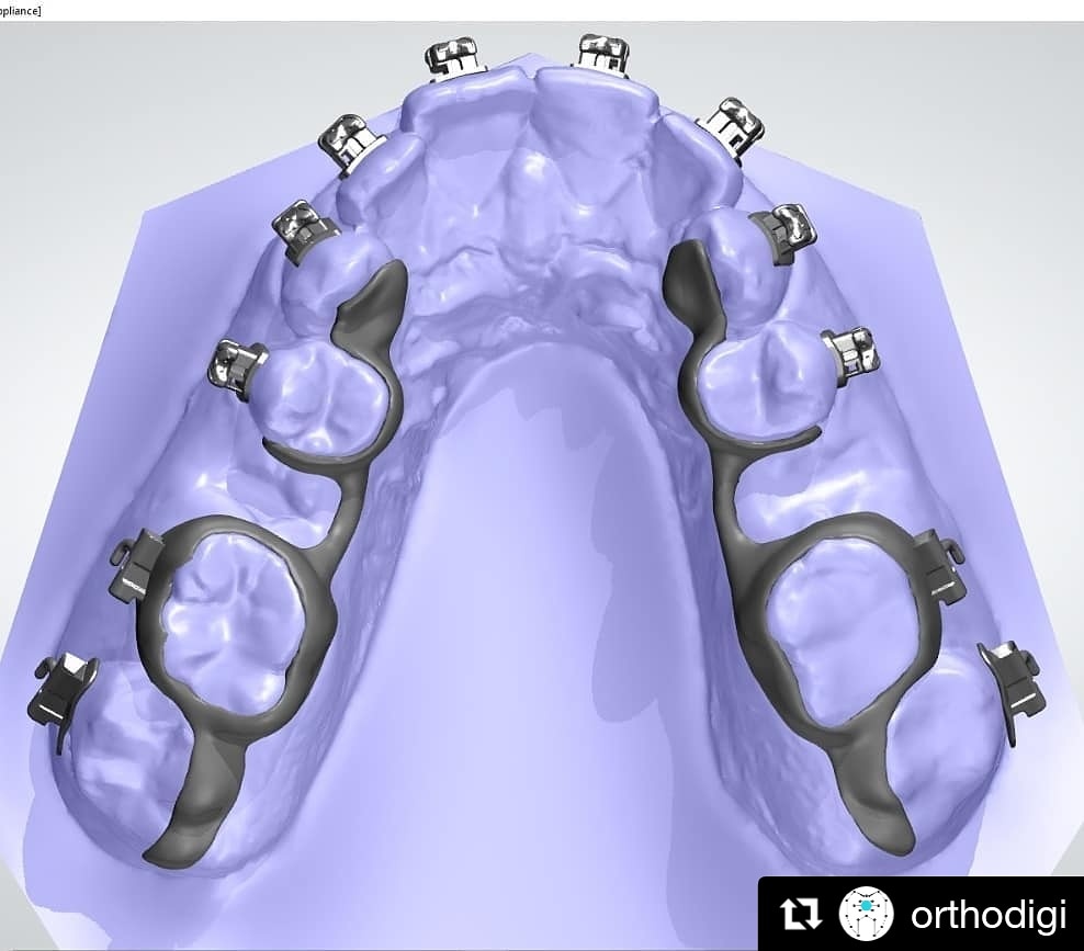 Çok güzel hareketler bunlar ↔️🤓 <a href="/Klinik45/">Klinik 45</a> #ortodontist Dr. <a href="/gizemaltug1984/">Gizem Altug</a> hanım ile beraber çalıştığımız RPE + Dibs 😌 

#digitaldentistry #Digitalorthodontics #aligners #dijitalortodonti #dijitaldişhekimliği #gömükdiş #ortodonti #ortodontist