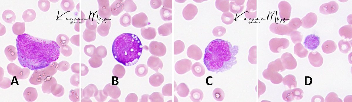 KMirza's tweet photo. Good morning #MedStudentTwitter and #PathTwitter - Let's play a game of #NameThatCell
Young adult with Burkitt lymphoma. Peripheral blood cells are shown.
Name cells A through D
#Hemepath #Lymsm #PathMatch21
@PathElective @loyolapathology @LoyolaOnc @LoyolaHemePath https://t.co/frtG9PjhZ4