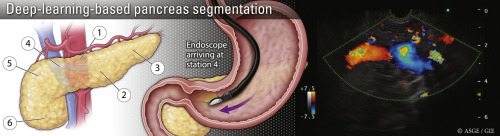 Check out “Deep learning–based pancreas segmentation and station recognition system in EUS: development and validation of a useful training tool” by Zhang et al. giejournal.org/article/S0016-…