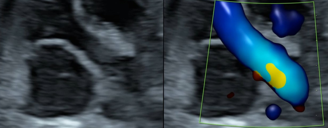 Join Dr Simon Meagher, Dr Balu Vaidyanathan & Dr P Brooks, via live stream on November 14, for our advanced cardiac course. Topics include Tetralogy of Fallot, Common Arterial Trunk and Double Outlet Right Ventricle. Register now to attend https://t.co/UPQ3bhBqLH #LoveUltrasound https://t.co/0els7F58Tc