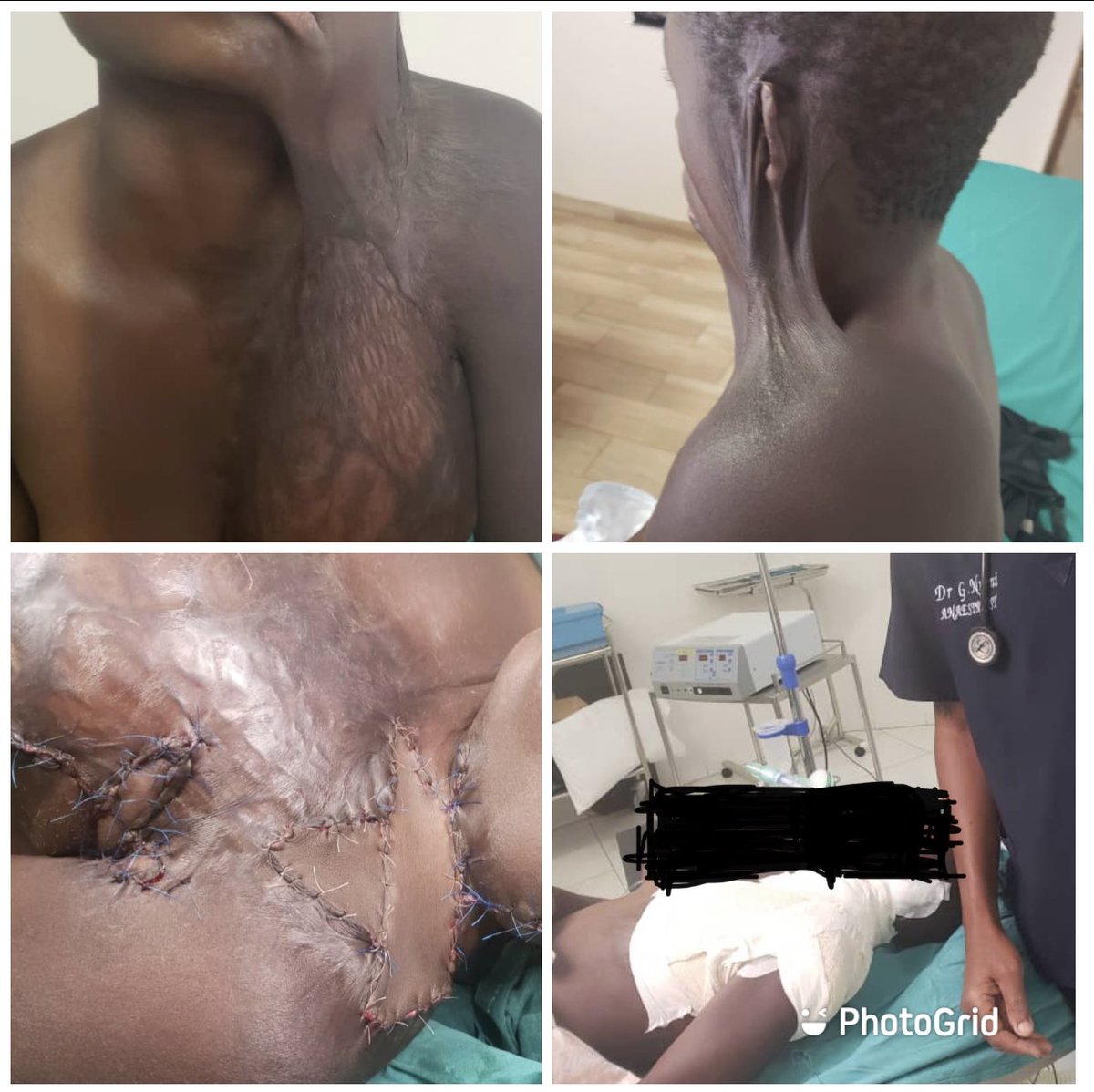 Today, @PlasticZim , myself and team did surgery on this young girl who had contractures on the neck secondary to neglected burns. Special thanks goes to <a href="/impalacarrental/">Impala Car Rental</a> and the many donors that made this possible.