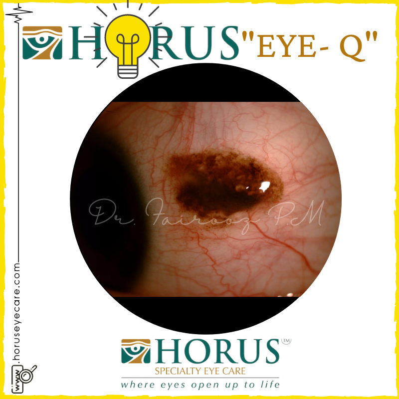 CancerEye's tweet photo. EYE- Q 😉

We have a #EYEquiz happening, participate from Instagram or Facebook...

Giveaway worth 50USD 🤩💃🕺

#HORUSgiveaway #DrFairoozPM #diagnose #clinicaltips #identify #instaquiz #knowledge #giveawaytime #giveawayalert #giveawayindia #quiztime #quizinstagram #quizmaster https://t.co/JMYBPK7Yhg