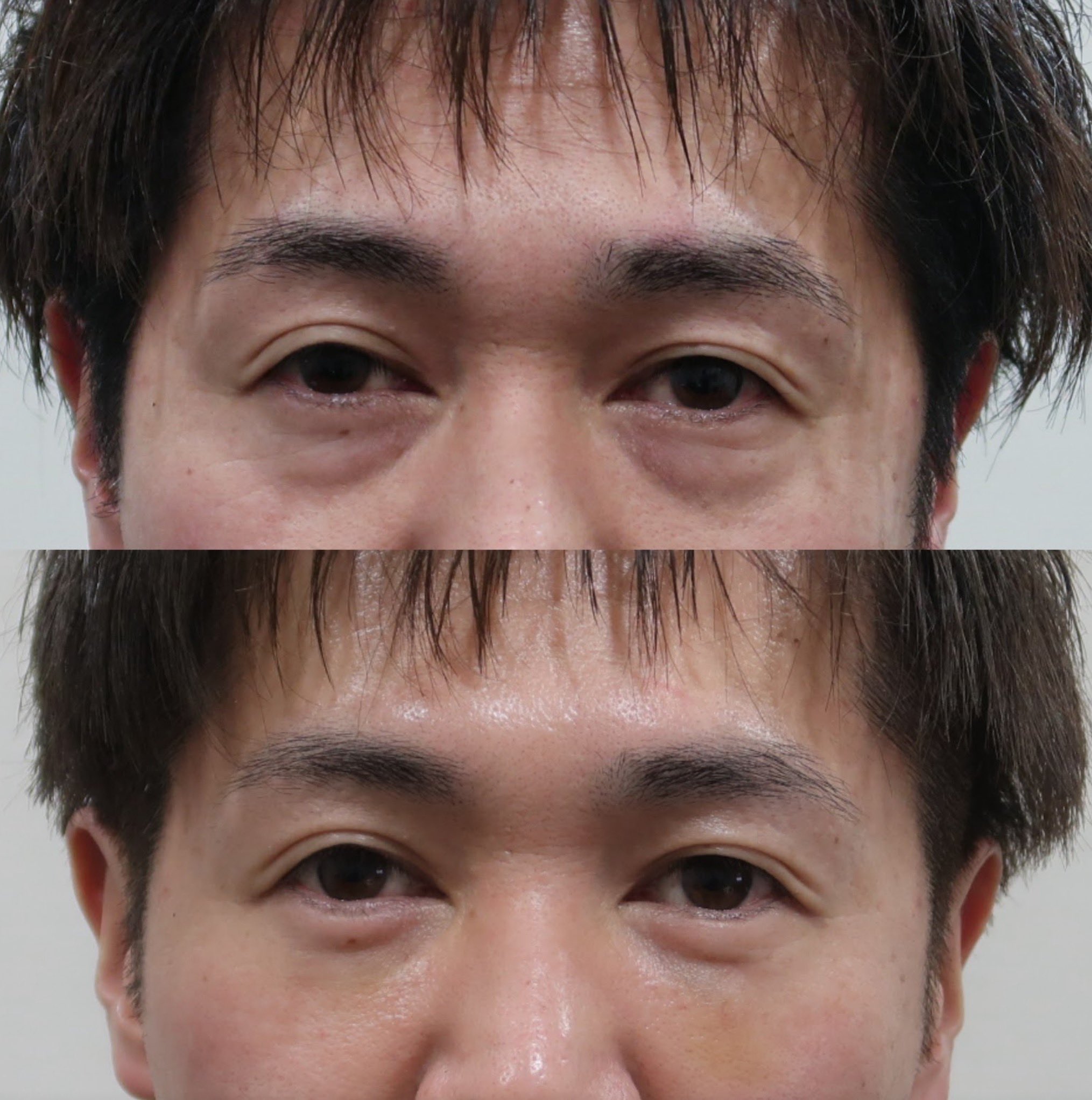 東京皮膚科形成外科 池田欣生 Yoshio Ikeda 当院オリジナルの切らない涙袋形成術 涙袋靭帯を引き締めて涙袋を形成した後 再生医療でクマ部分の皮膚を若返らせます 下は術後1週 眼輪筋が引き上げられるので目が開きやすく 大きくなっているのが分かり