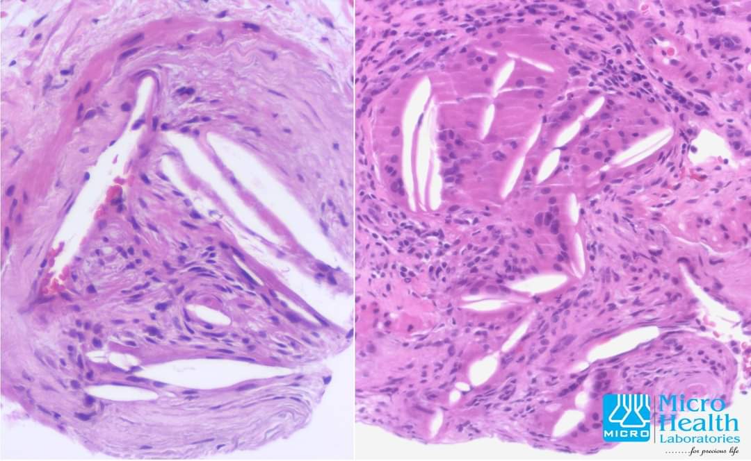  #renalpath  #vascularpathologyThe microscopic photograph shown  is from a patient who had a vascular procedure and presented with renal dysfunction. Cholesterol emboli were seen in the arcuate, interlobar and interlobular arteries as well as arterioles.