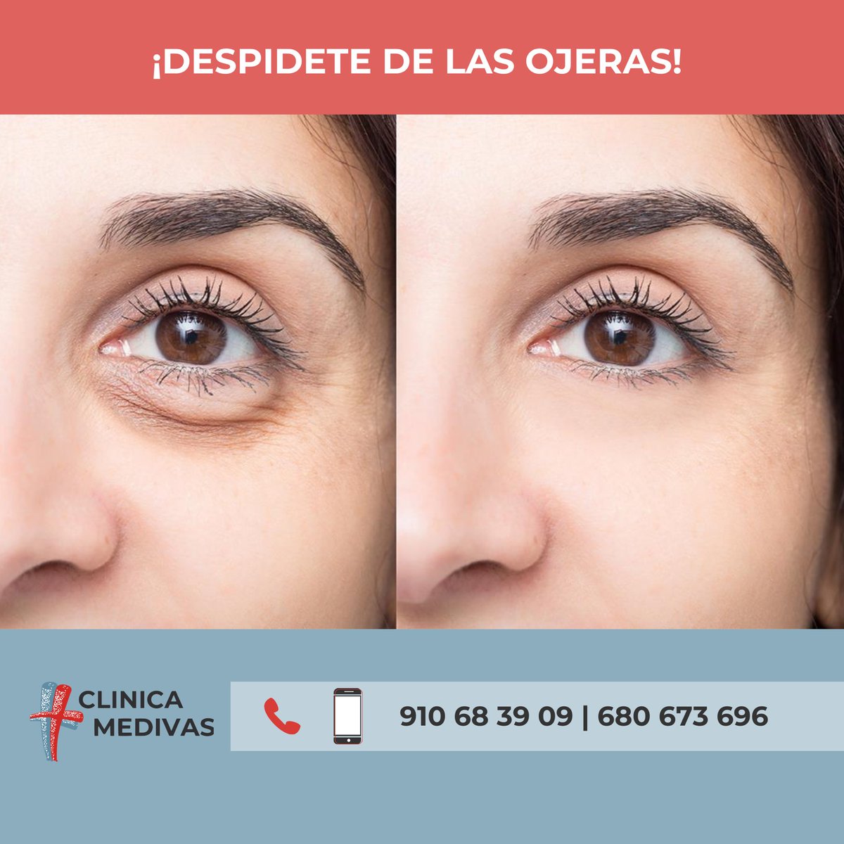 clinicamedivas's tweet photo. Despídete de las ojeras sin cirugía ✔️¡Elimina el aspecto cansado y triste de tu mirada! 
Consúltanos:
📞 910 068 39 09 / 680 673 696
📩 info@clinicamedivas.net
📍C/Principe de Vergara 57-59, Madrid, España
📌 https://t.co/HSyS4aqzy3
#ojeras #adiosojeras https://t.co/9XSluii7wJ