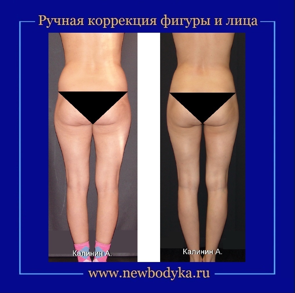 липопластика от целлюлита. ручную пластику тела. ручная коррекция фигуры. ручную пластику тела. пластика всего тела иркутск.