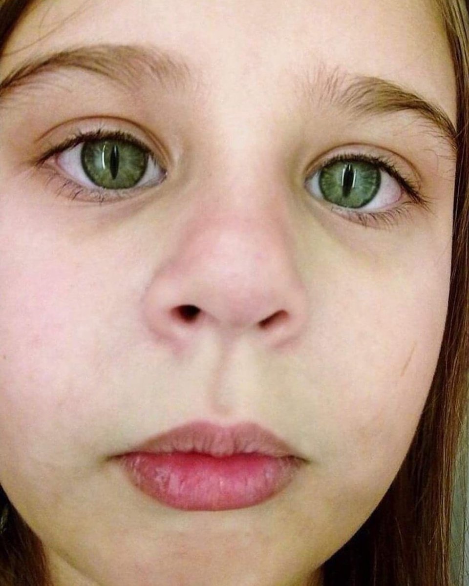 Atome De Savoir Le Syndrome Des Yeux De Chats Est Une Maladie Genetique Qui Donne Aux Yeux La Forme De La Pupille Du Chat Elle Est Due A Atome De Savoir Le Syndrome Des Yeux De Chats Est Une Maladie Genetique Qui Donne Aux Yeux La Forme De La Pupille Du Chat Elle Est Due A