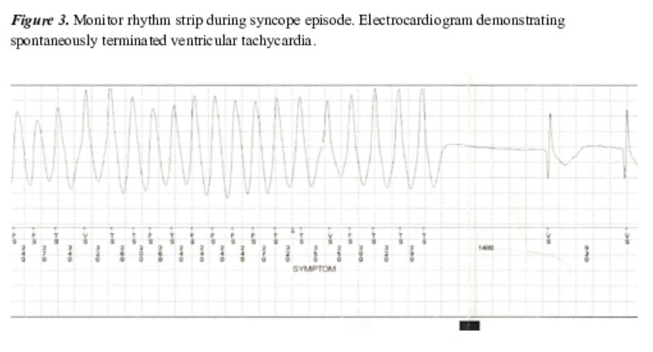 gbiondizoccai's tweet photo. Diagnostic yield of implantable loop recorders in patients with unexplained syncope: single-centre experience, by Kajdič et al
https://t.co/EaxAiSw6vG
#MinervaCardioangiologica
#syncope #looprecorder #diagnosisdetectives https://t.co/MtsE4Qn9wA