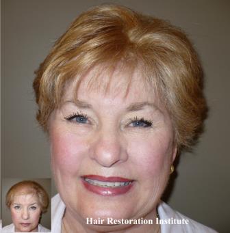 hriofmn's tweet photo. Jan...a lovely lady who was tired of seeing her scalp in the front area of her hair.  

Book your virtual consultation today at our MN location: https://t.co/OXKN84REMi https://t.co/VRmugXsm1N