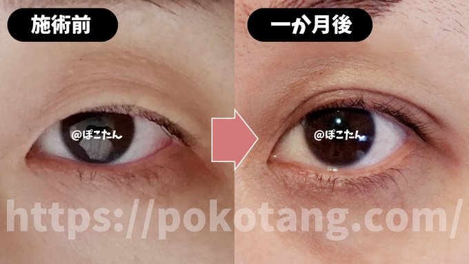 二重まぶたの種類を解説 末広 並行や施術別の相場も丸わかり Beauty Press