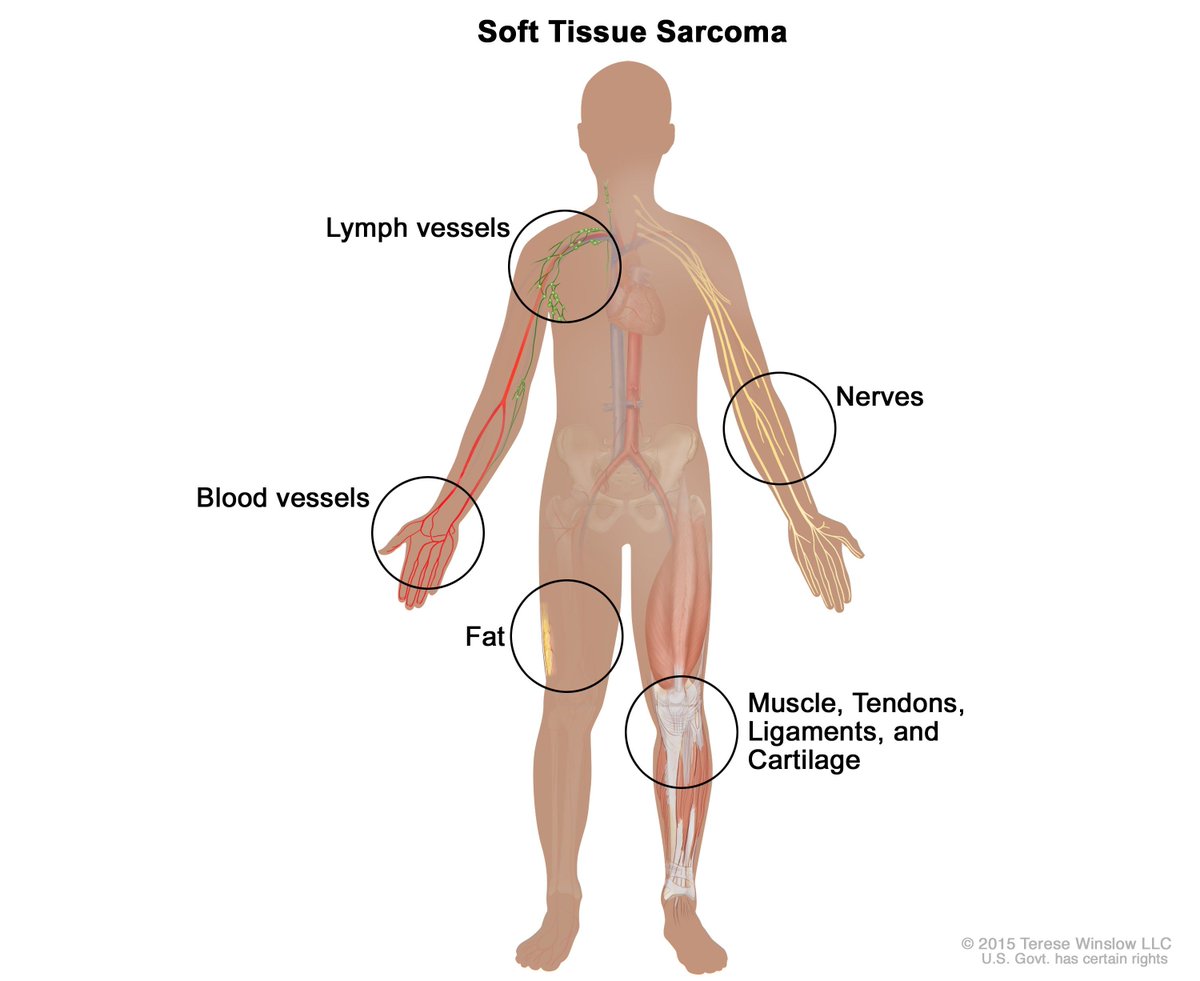 NCICancerStats's tweet photo. #SoftTissueCancer, also known as #SoftTissueSarcoma, is a broad term for cancers that start in soft tissues (muscle, tendons, fat, lymph and blood vessels, and nerves). Take a look at our fact sheet for more information: https://t.co/SC3sV1jiJm https://t.co/ZygacgdFpy