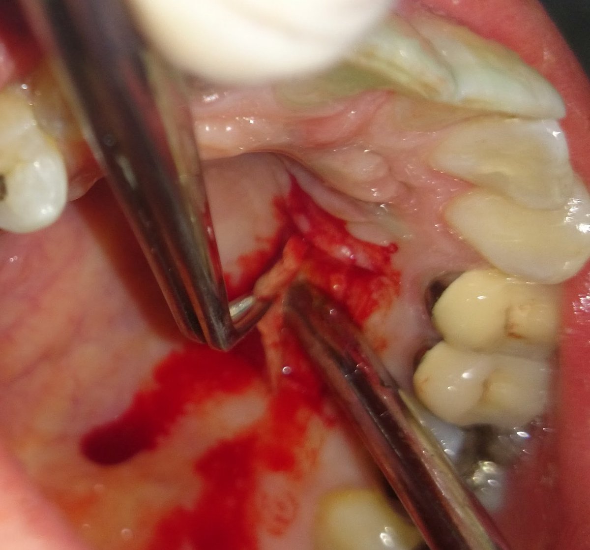 aypzp's tweet photo. Injerto libre epitelial para aumento de encia insertada, la falta de ella + frenillo aberrante + fenotipo peridontal + tx ortodontico +dehisencia ósea = probable recesion gingival. @Eduardoarsa https://t.co/QLJKOC50zM