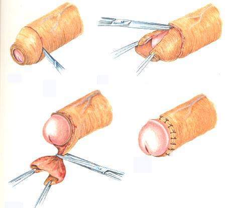 kalimat bohong ayah diwaktu kecil:

"sunat gak sakit, cuma kayak digigit semut"

dari kecil aja laki-laki sudah di bohongin apalagi kalau sudah dewasa.