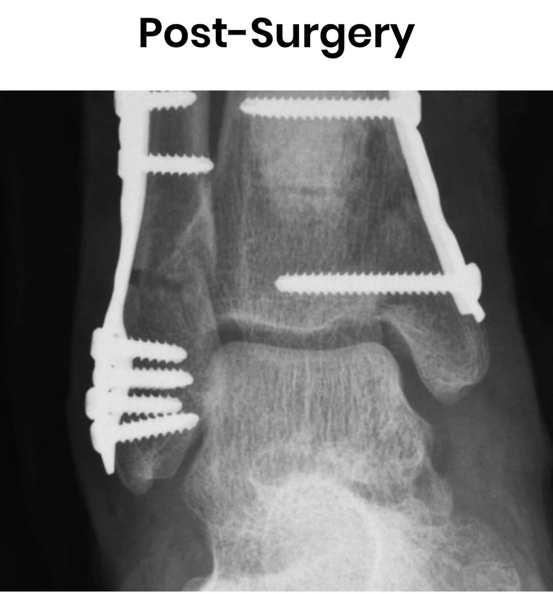 Randon Hall Md On Twitter Here Is An Idea Of What Dak Prescott Is Looking At For Surgery Tonight Full Recovery Typically In The 6 Month Range He Ll Be Back Dallascowboys Nfl Randon Hall Md On Twitter Here Is An Idea Of What Dak Prescott Is Looking At For Surgery Tonight Full Recovery Typically In The 6 Month Range He Ll Be Back Dallascowboys Nfl