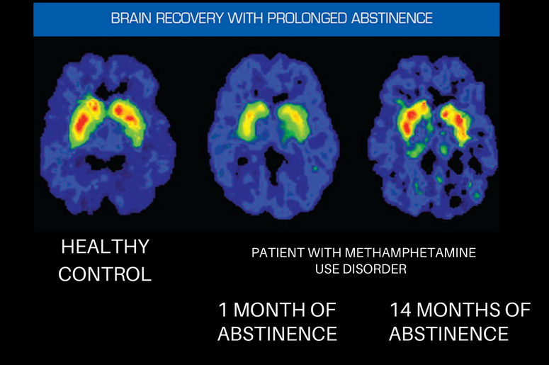 Different drugs cause different changes in the brain, as well,In addition to the dopamine dysfunction.These changes are observable on MRI's and can last from 3 months to years after drug or alcohol cessation.7/8