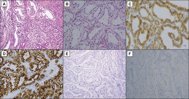 The Clinicopathologic and Molecular Landscape of Clear Cell Papillary Renal Cell Carcinoma: Implications in Diagnosis and Management 
buff.ly/36SJT1d
<a href="/StanleyWeng_/">Stanley Weng</a> <a href="/arihakimi/">ari hakimi</a> <a href="/renzogdg/">Renzo G. DiNatale</a> <a href="/AndSilagy/">Andrew Silagy</a> <a href="/KAttallaMD/">Kyrollis Attalla, MD</a> <a href="/mahyarkashaniMD/">Mahyar Kashani</a> @sloan_kettering