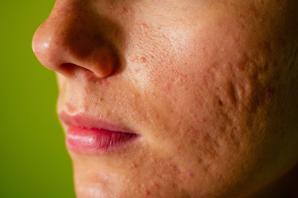 DermTimesNow's tweet photo. There is a dire need to improve the clinical tools dermatologists use to assess the severity of #acnescars. This 3D imaging technique may help, according to a recent study presented at the 2020 virtual ASDS meeting. https://t.co/LAXKfSiUSW #ASDS2020 https://t.co/UMLmJQ0Sc2